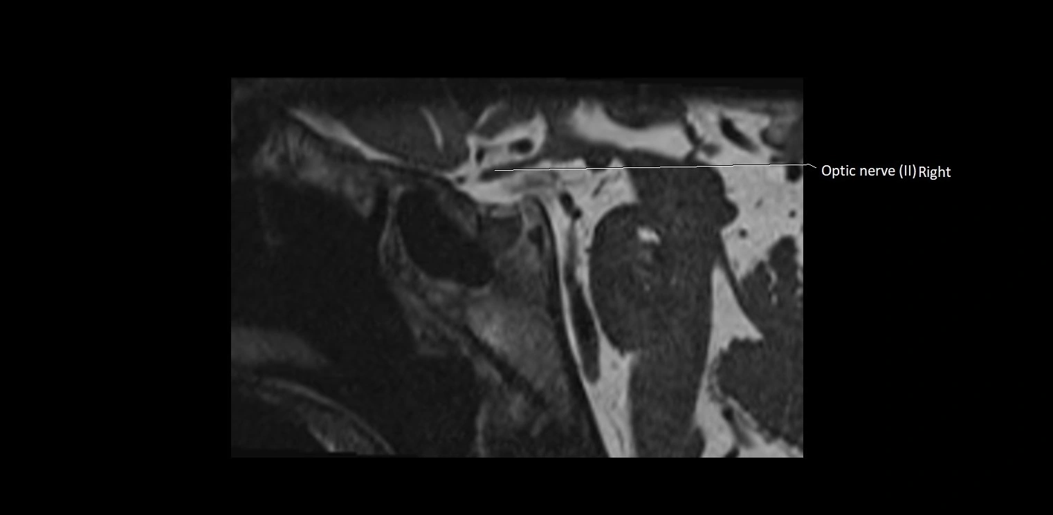 Cranial nerve sagittal anatomy MRI 3T image 34.webp